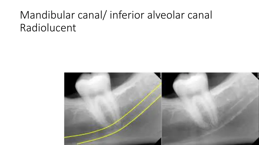 mandibular canal inferior alveolar canal