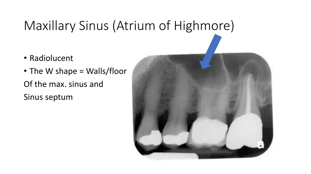 maxillary sinus atrium of highmore