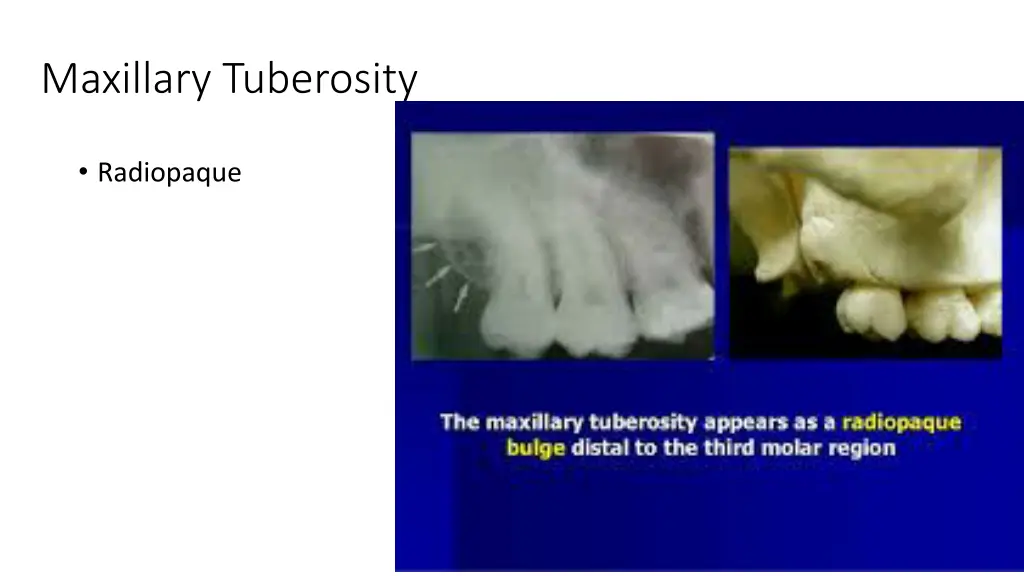 maxillary tuberosity