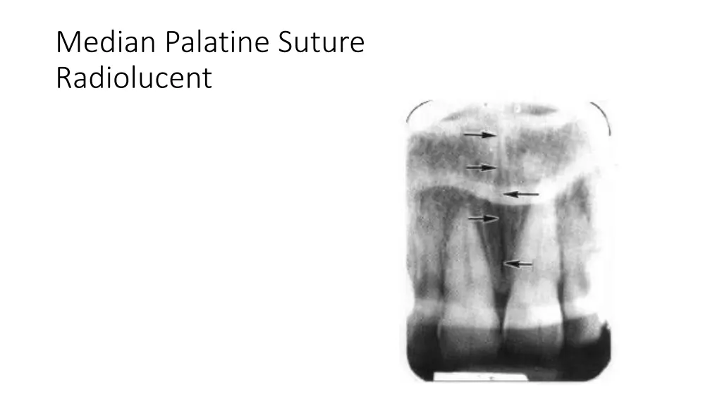 median palatine suture radiolucent