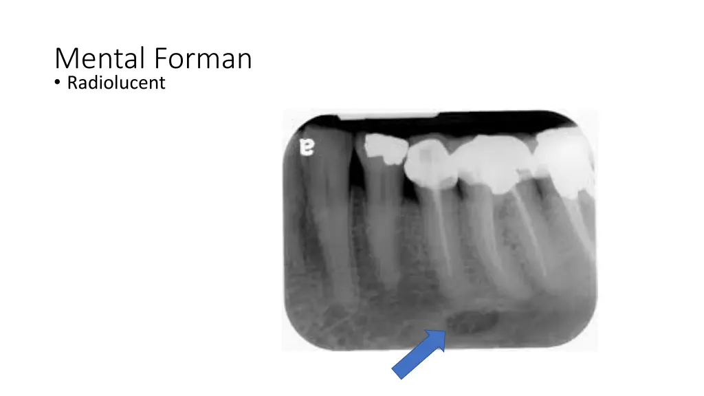 mental forman radiolucent