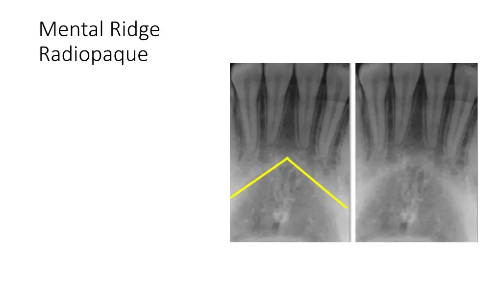 mental ridge radiopaque