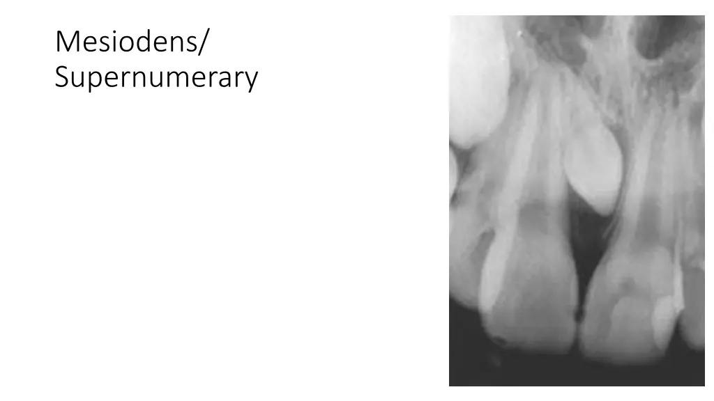 mesiodens supernumerary