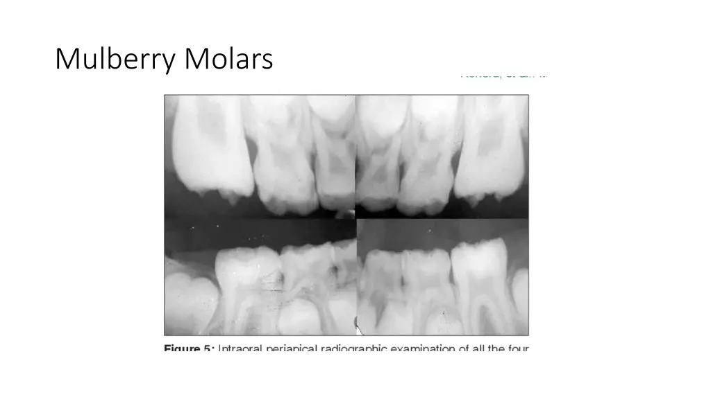 mulberry molars