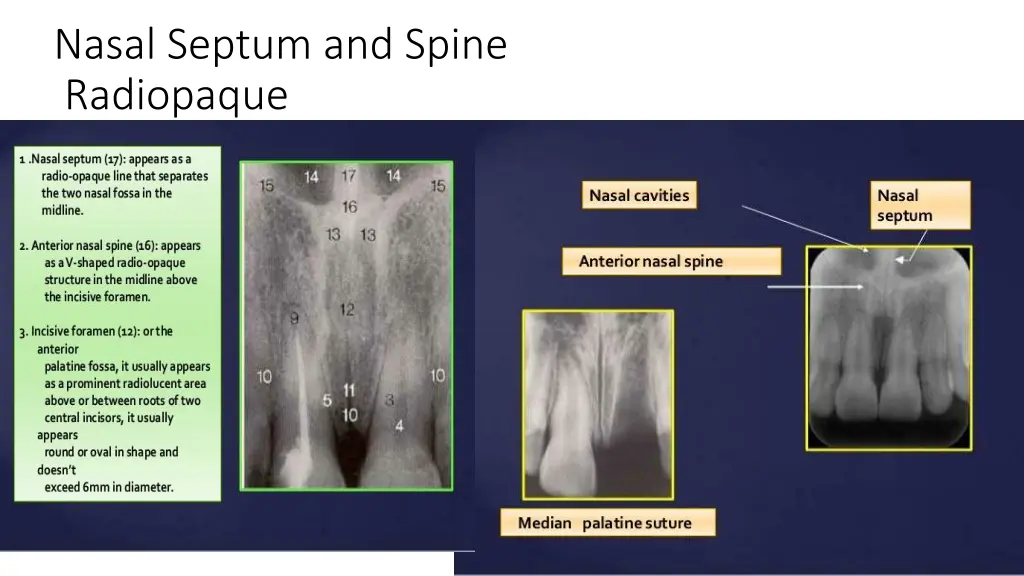 nasal septum and spine radiopaque