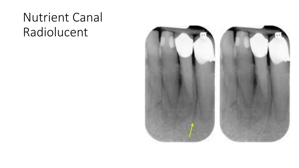 nutrient canal radiolucent