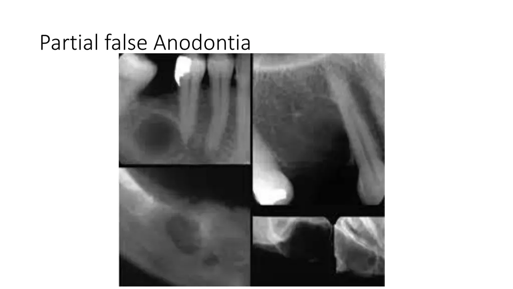 partial false anodontia