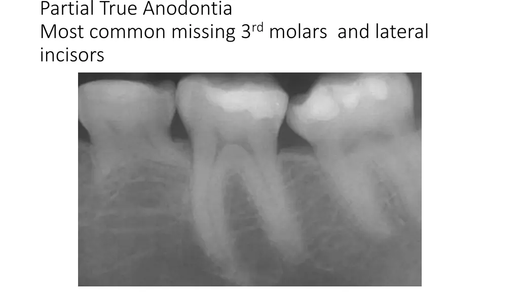 partial true anodontia most common missing