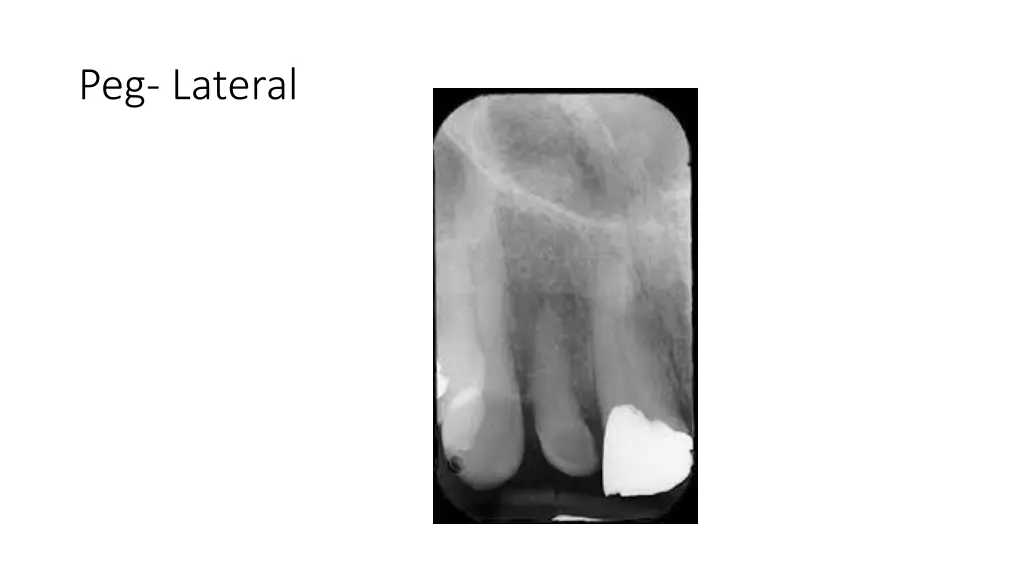 peg lateral