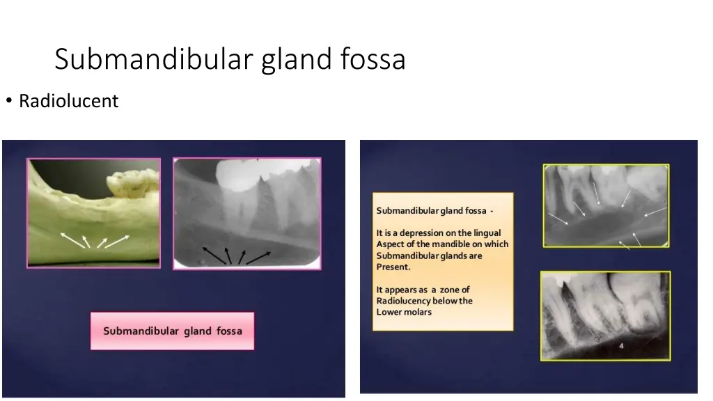 submandibular gland fossa