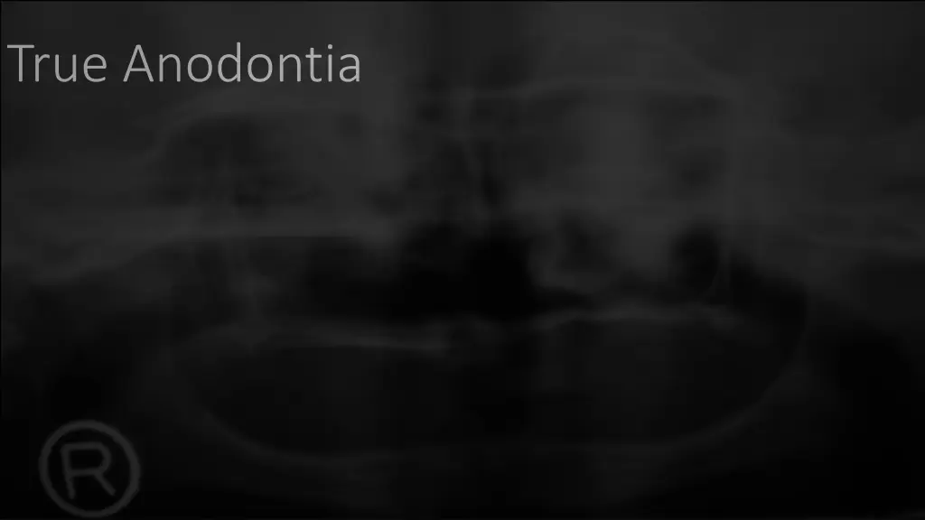 true anodontia