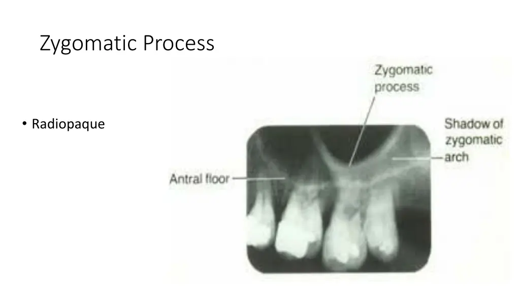 zygomatic process