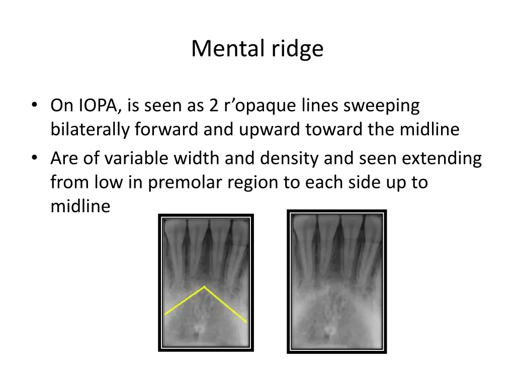 mental ridge