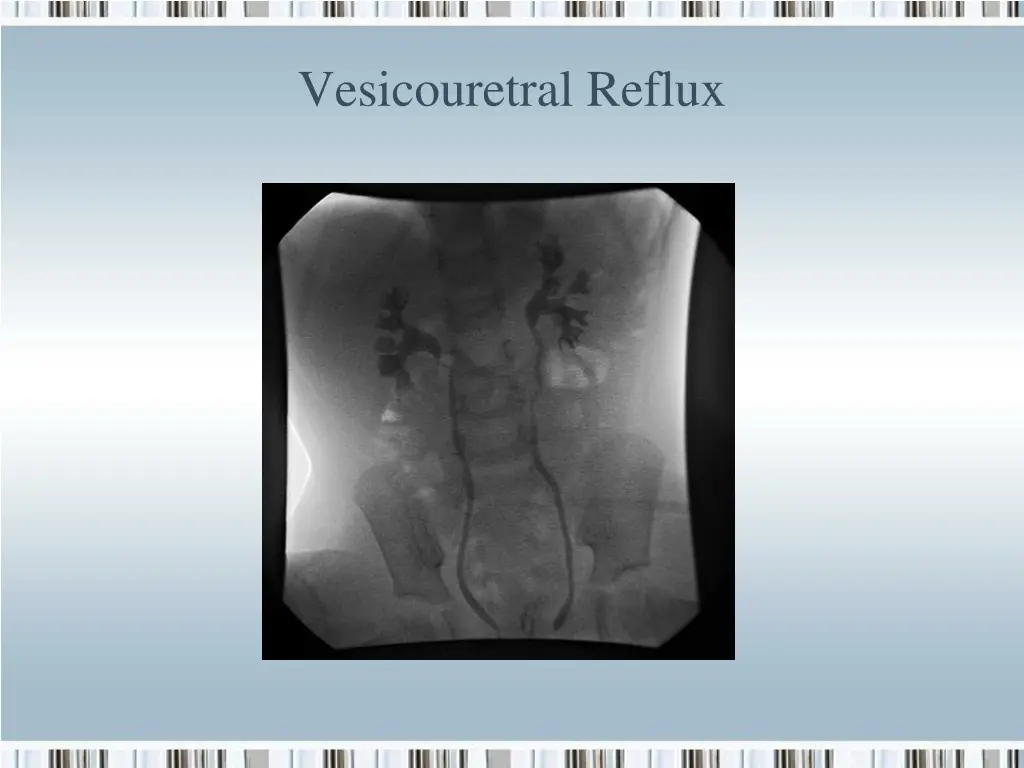 vesicouretral reflux