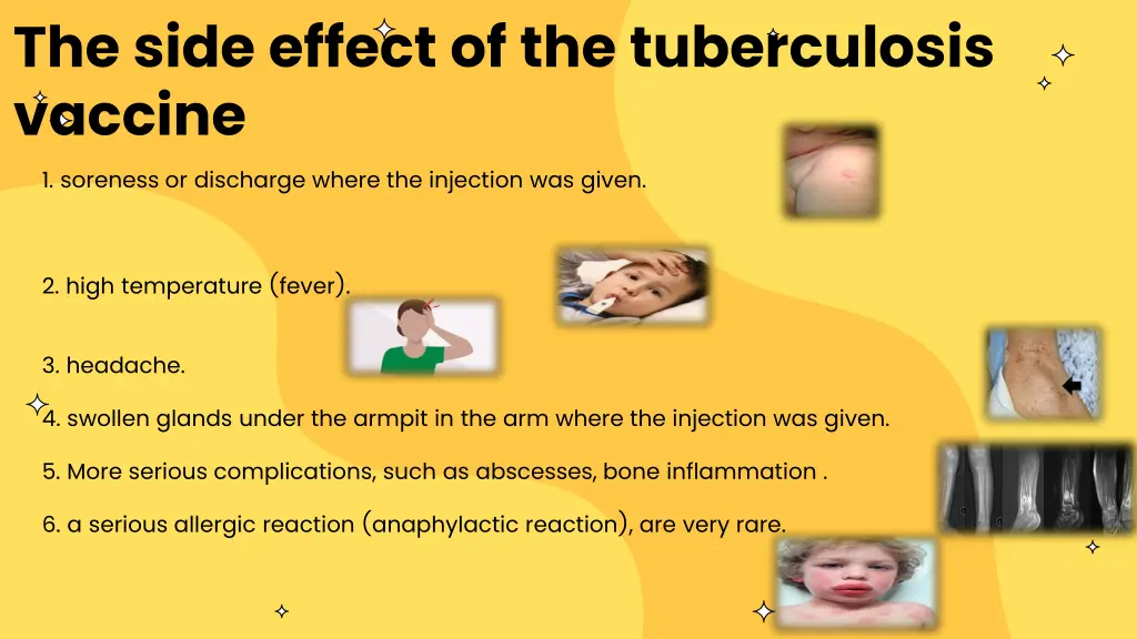 the side effect of the tuberculosis vaccine