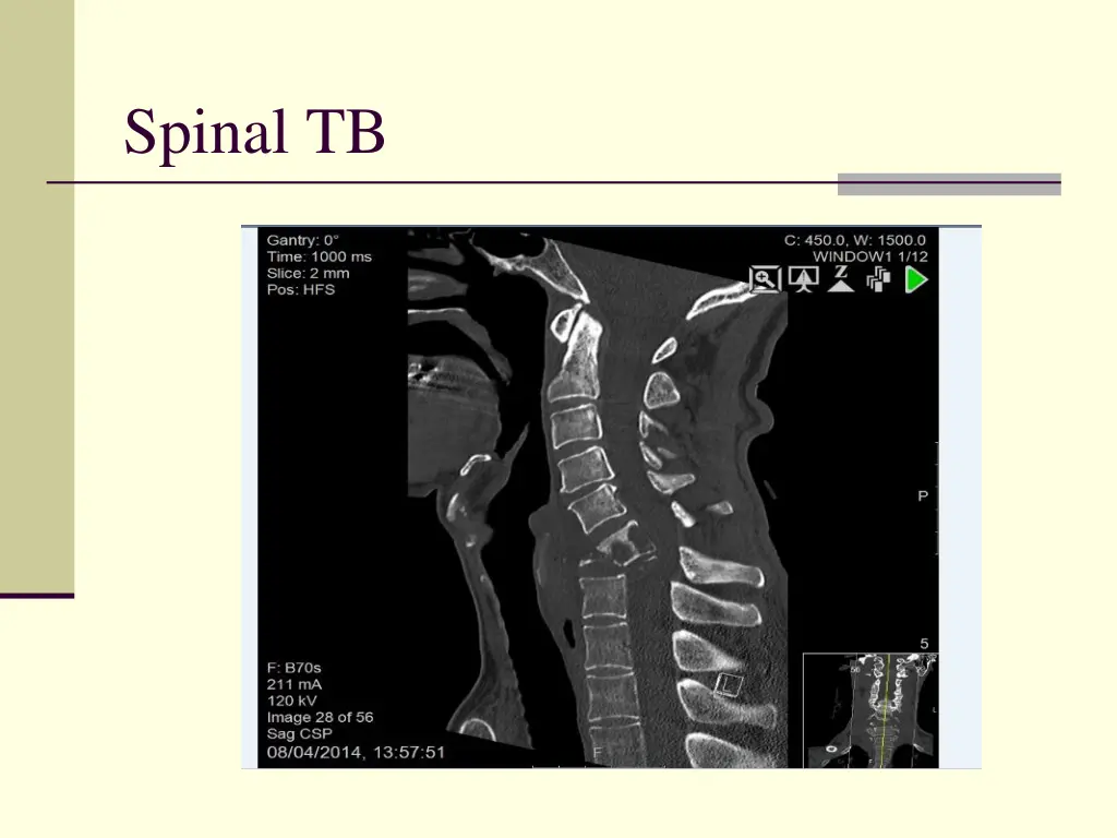 spinal tb