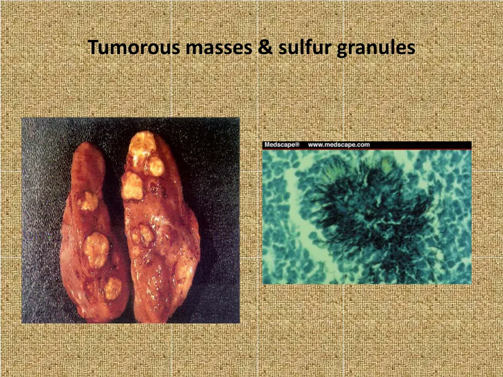 tumorous masses sulfur granules