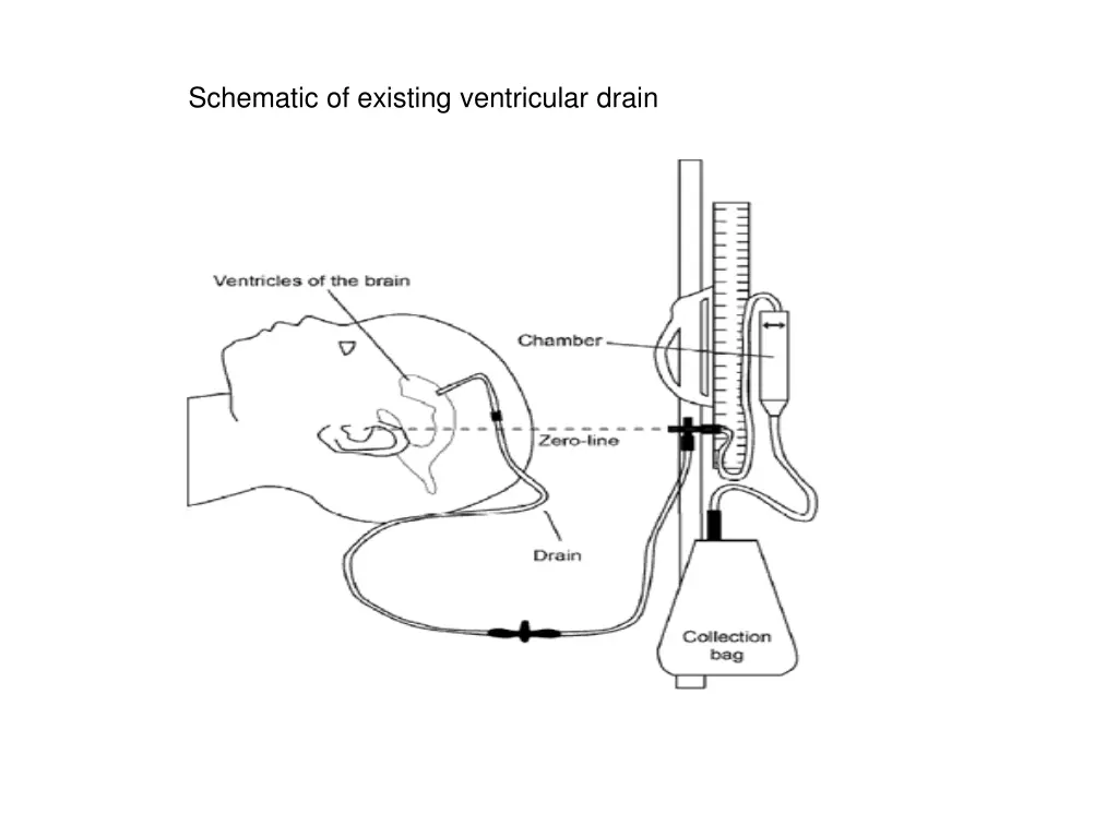 schematic of existing ventricular drain