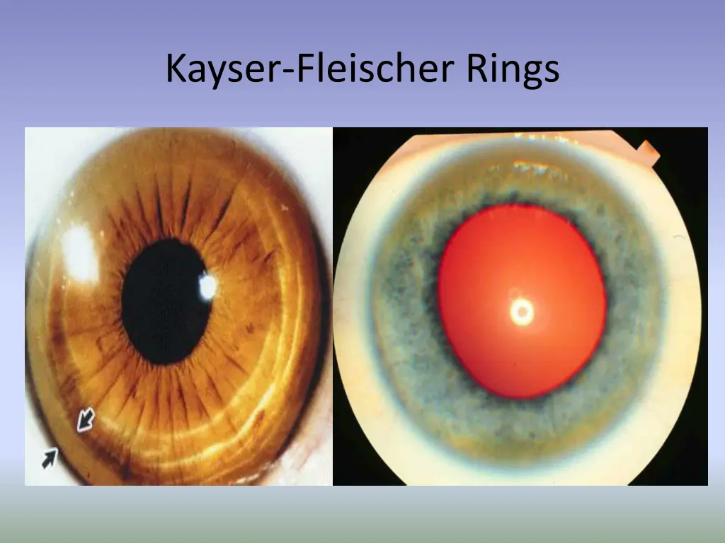 kayser fleischer rings