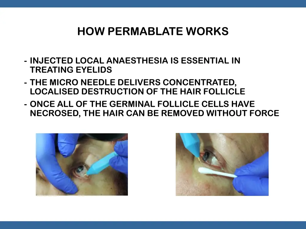 how permablate works