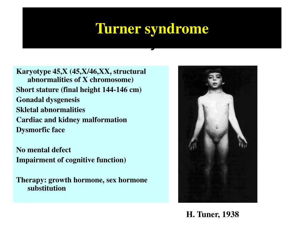 turner syndrome
