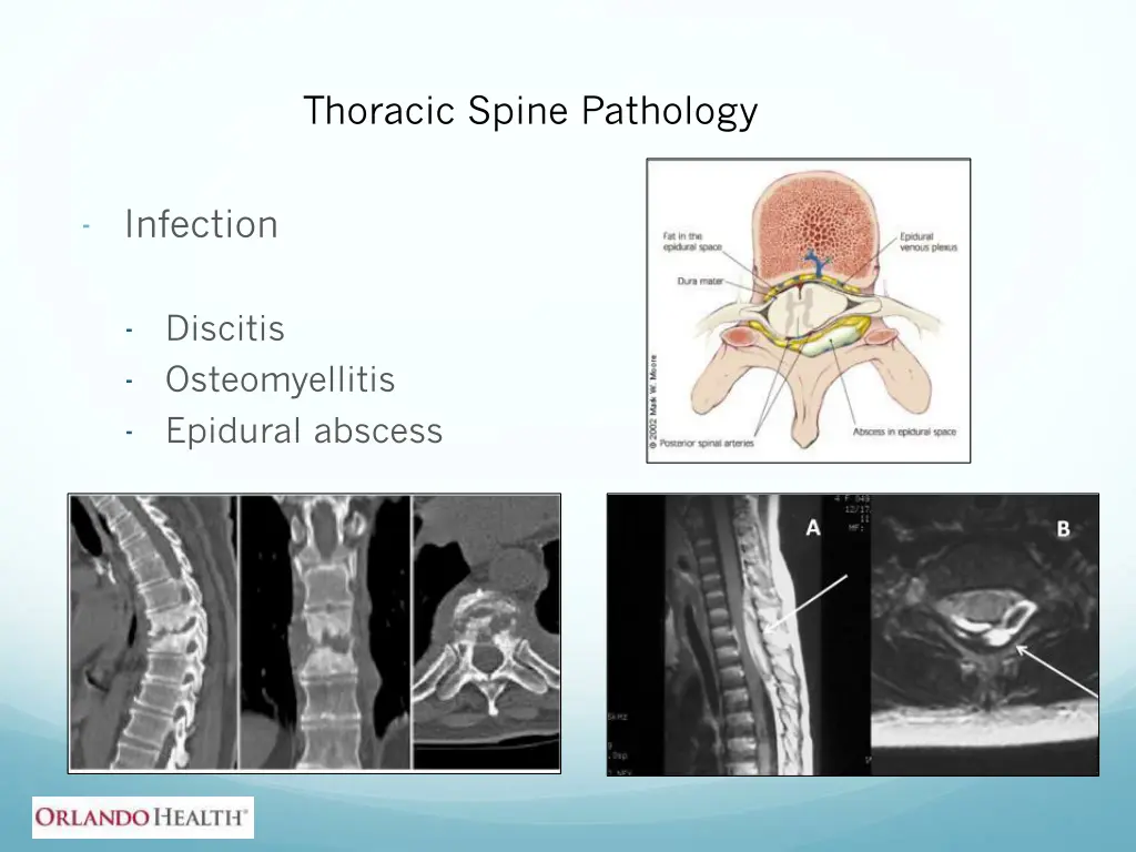 thoracic spine pathology 5