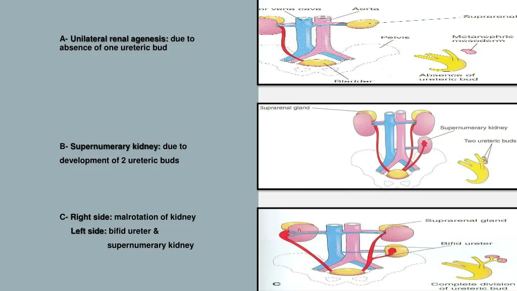 a unilateral renal agenesis due to absence