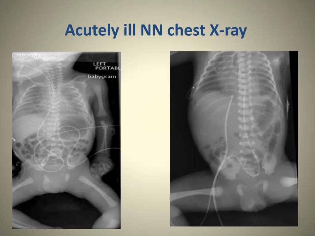 acutely ill nn chest x ray