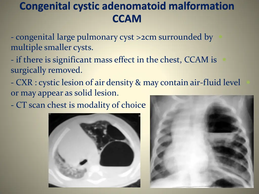 congenital cystic adenomatoid malformation ccam