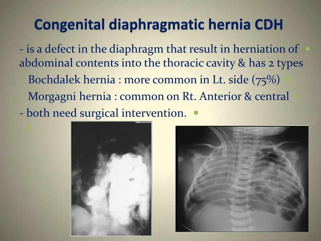 congenital diaphragmatic hernia cdh