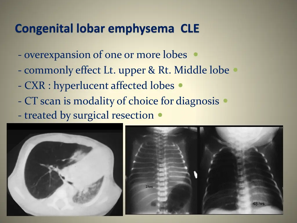 congenital lobar emphysema cle