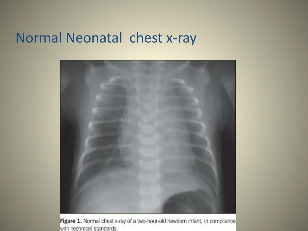 normal neonatal chest x ray