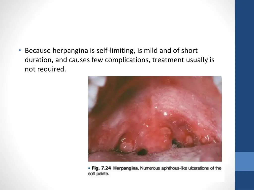 because herpangina is self limiting is mild