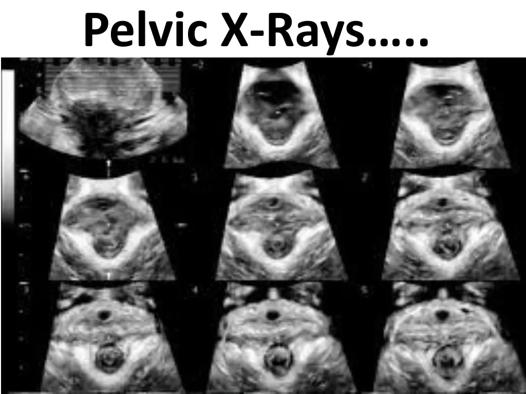 pelvic x rays