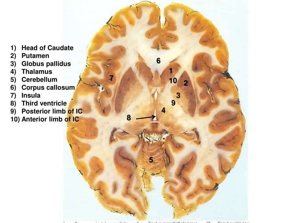 1 head of caudate 2 putamen 3 globus pallidus