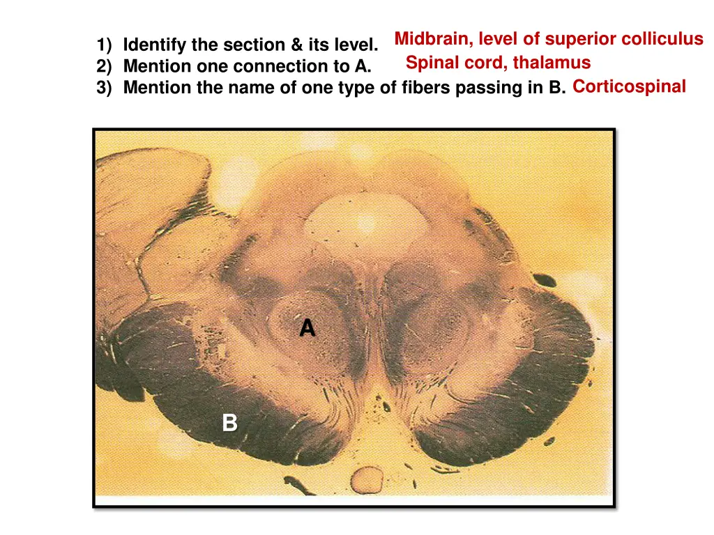 midbrain level of superior colliculus spinal cord