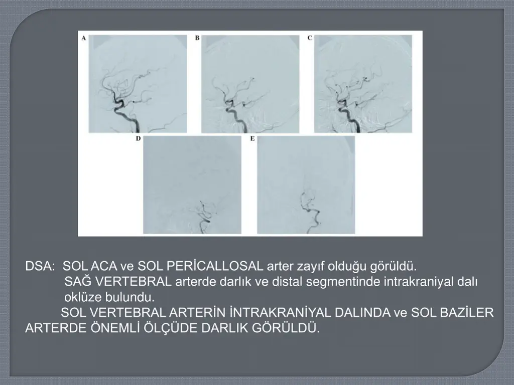 dsa sol aca ve sol per callosal arter zay f oldu
