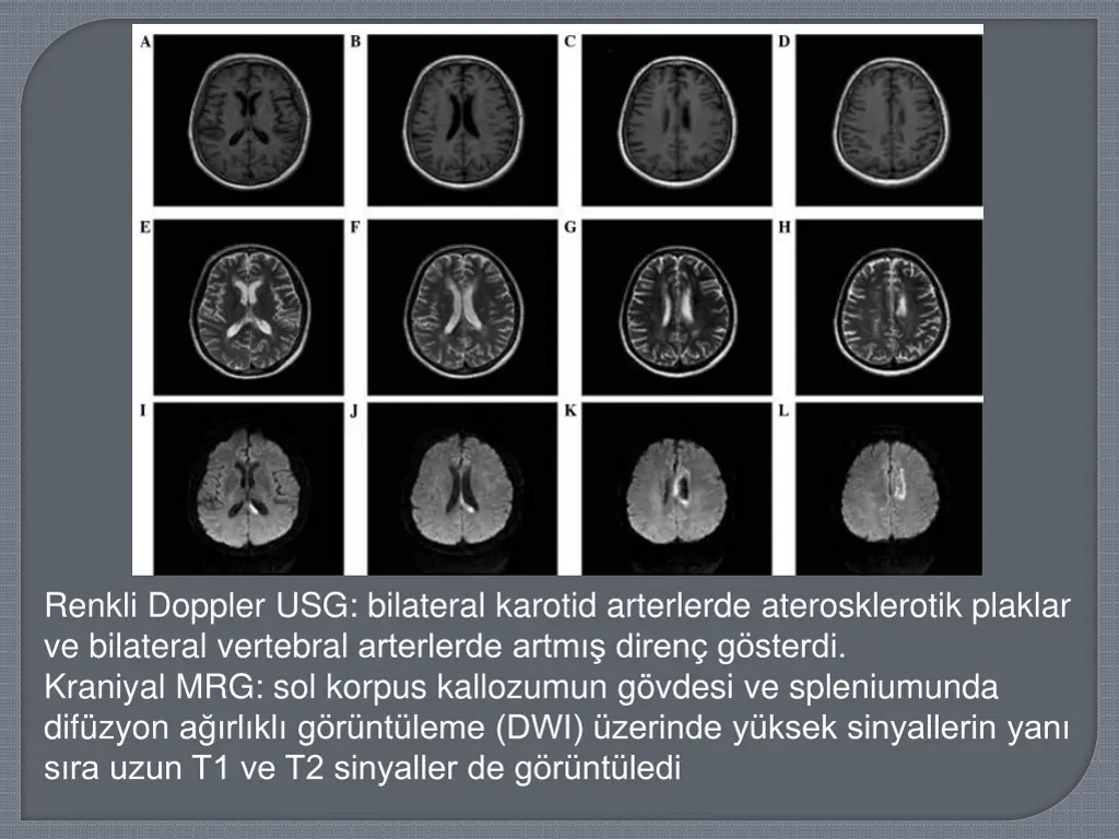 renkli doppler usg bilateral karotid arterlerde