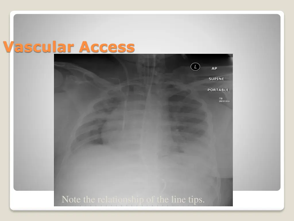 vascular access 1