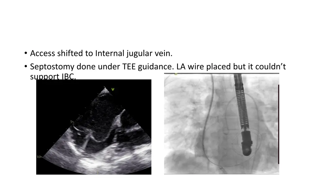 access shifted to internal jugular vein