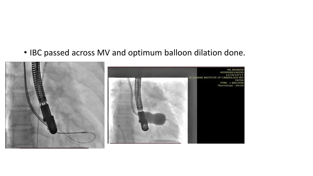 ibc passed across mv and optimum balloon dilation
