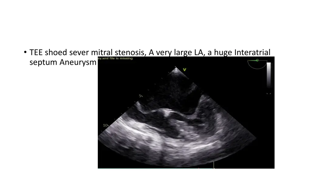 tee shoed sever mitral stenosis a very large
