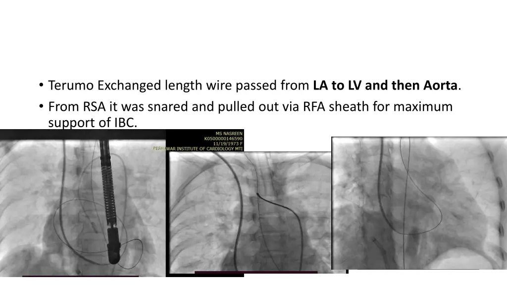 terumo exchanged length wire passed from