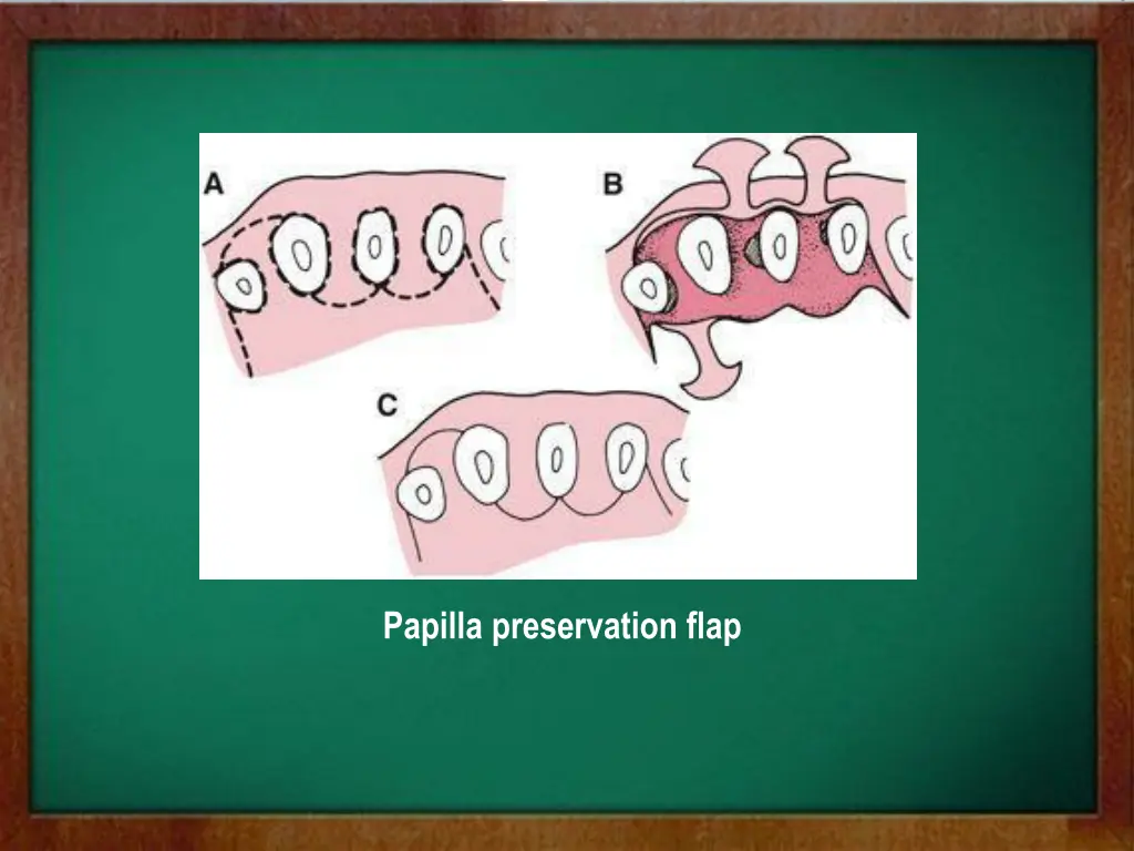 papilla preservation flap 1