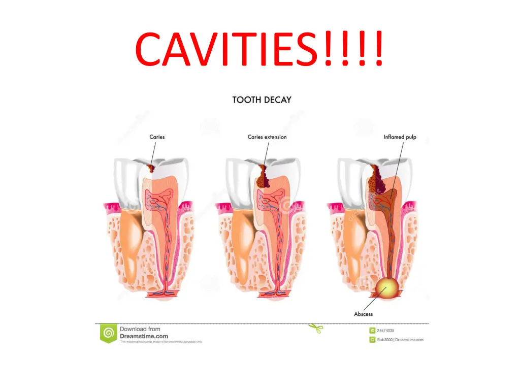 cavities 1
