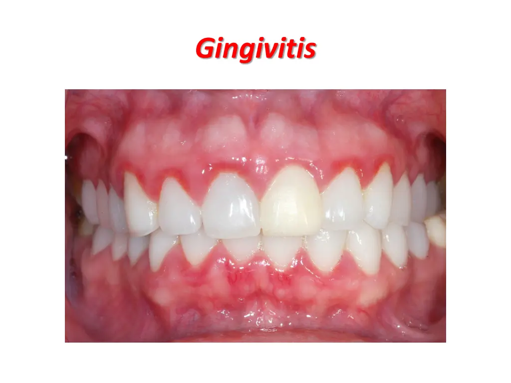 gingivitis 1