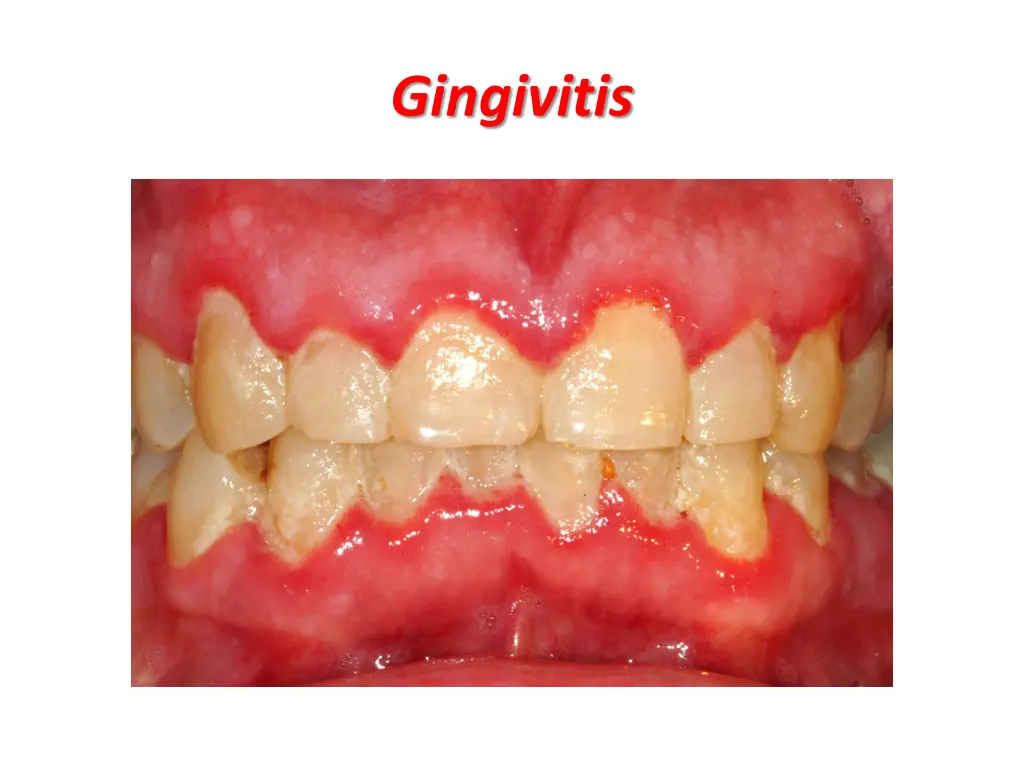 gingivitis 2