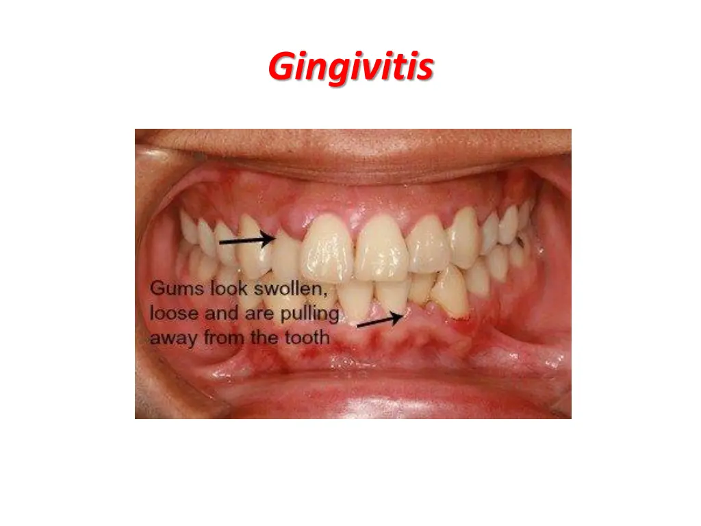 gingivitis