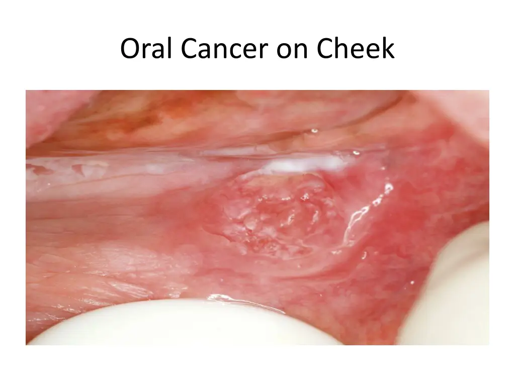 oral cancer on cheek