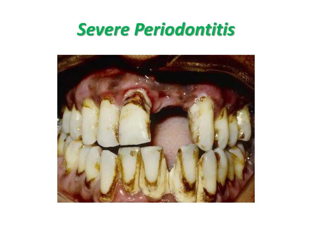 severe periodontitis 1